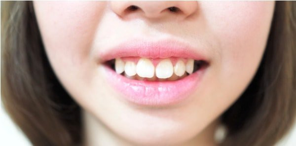 Răng cửa bị hô: bọc răng sứ có phải giải pháp hiệu quả nhất